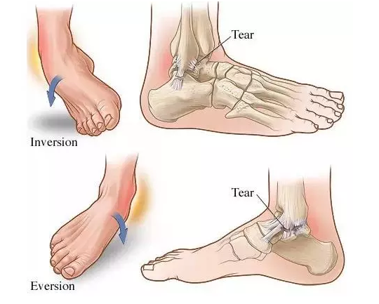 超声骨密检测仪分享扭伤脚踝正确的处理方法。